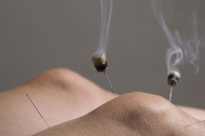 Moxibustion warms acupuncture needles and helps drive out the cold
